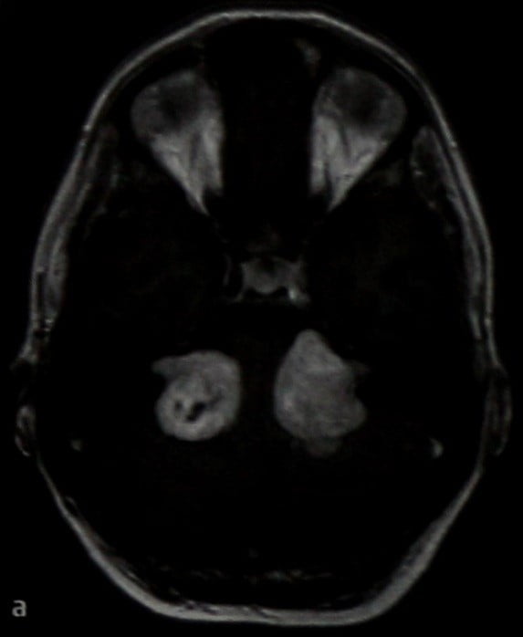 Снимки МРТ и КТ. Нейрофиброматоз II типа