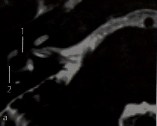 Снимки МРТ и КТ. Шваннома вестибулярного нерва