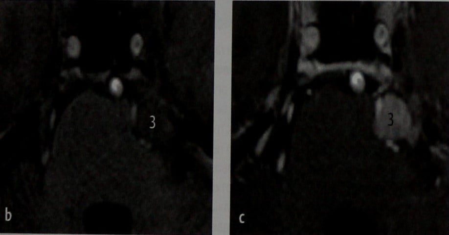 Снимки МРТ и КТ. Шваннома тройничного нерва
