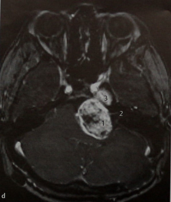 Снимки МРТ и КТ. Шваннома тройничного нерва
