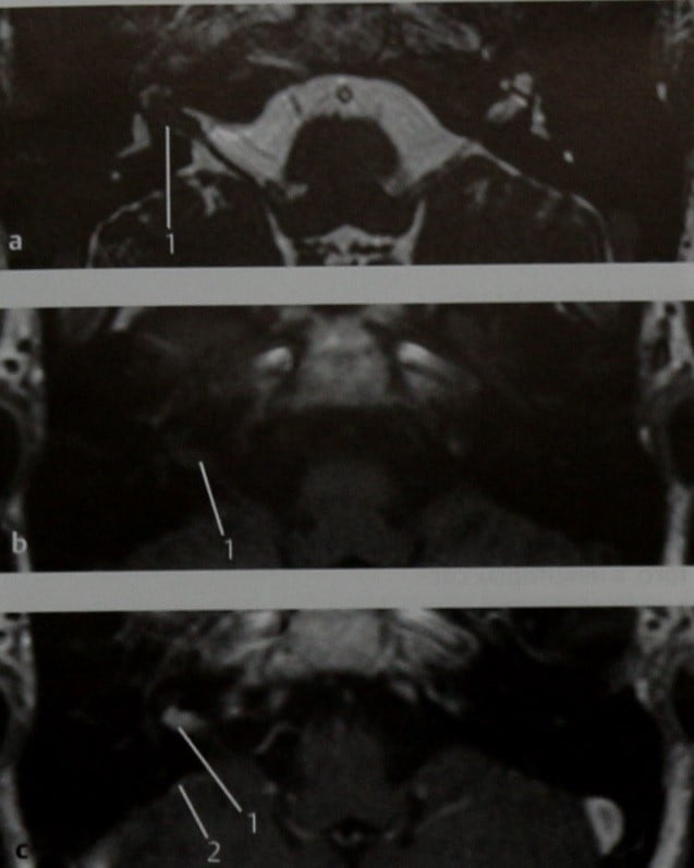 Снимки МРТ и КТ. Отосифилис и интракраниальные осложнения