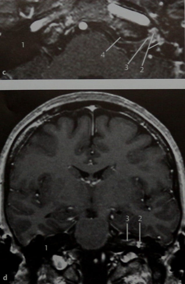 Снимки МРТ и КТ. Лабиринтит и менингит со стертой клиникой