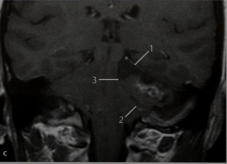 Снимки МРТ и КТ. Астроцитома мостомозжечкового угла