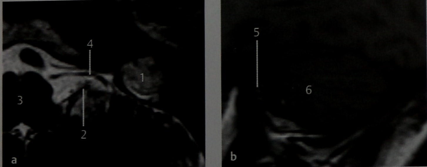 Снимки МРТ и КТ. Эпидермоидная киста