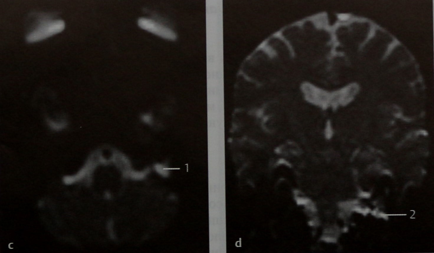 Снимки МРТ и КТ. Эпидермоидная киста