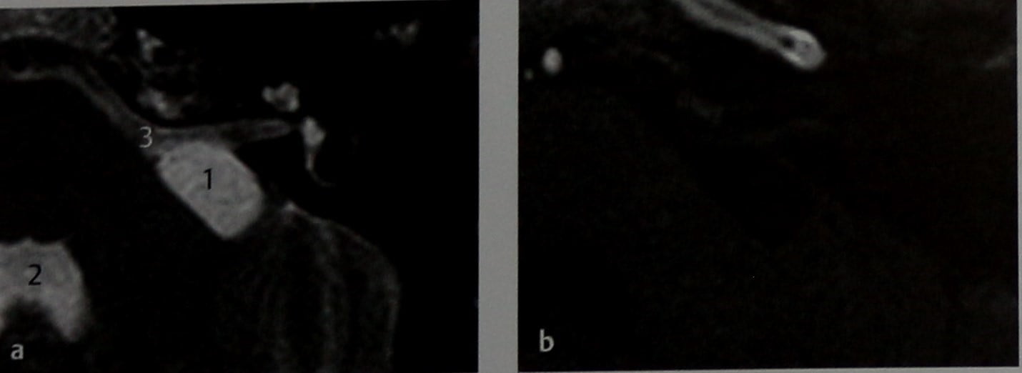 Снимки МРТ и КТ. Арахноидальные кисты