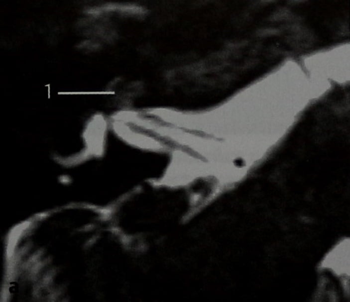 Снимки МРТ и КТ. Шваннома улиткового нерва