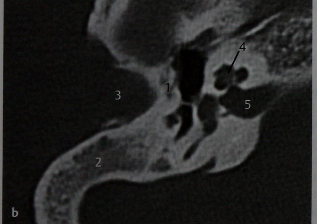 Снимки МРТ и КТ. Холестеатома и атрезия наружного слухового прохода
