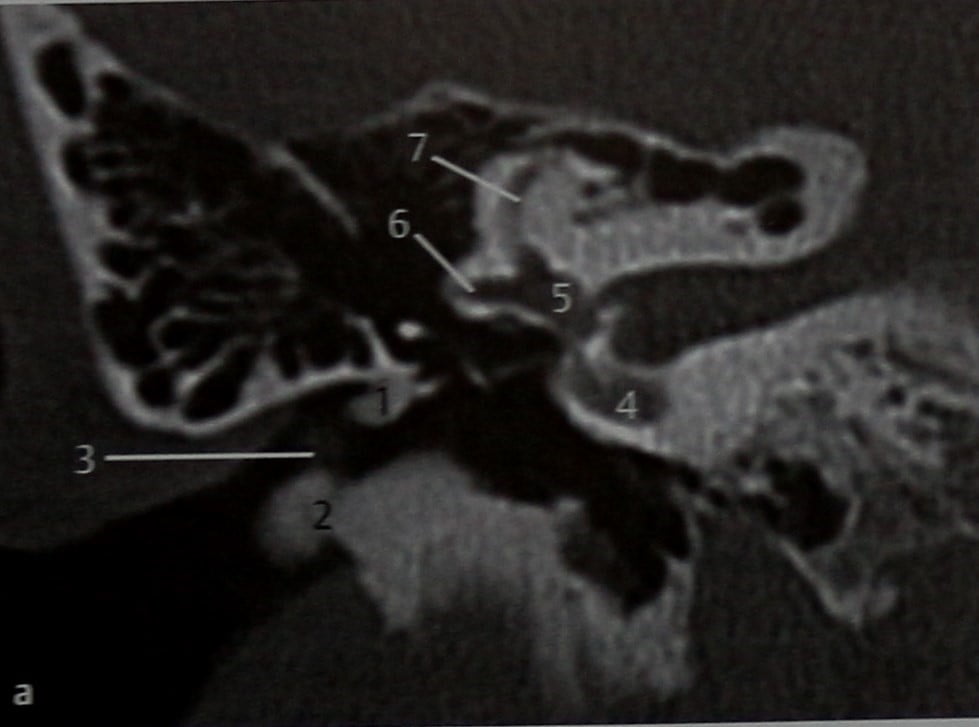 Снимки МРТ и КТ. Экзостозы наружного слухового прохода