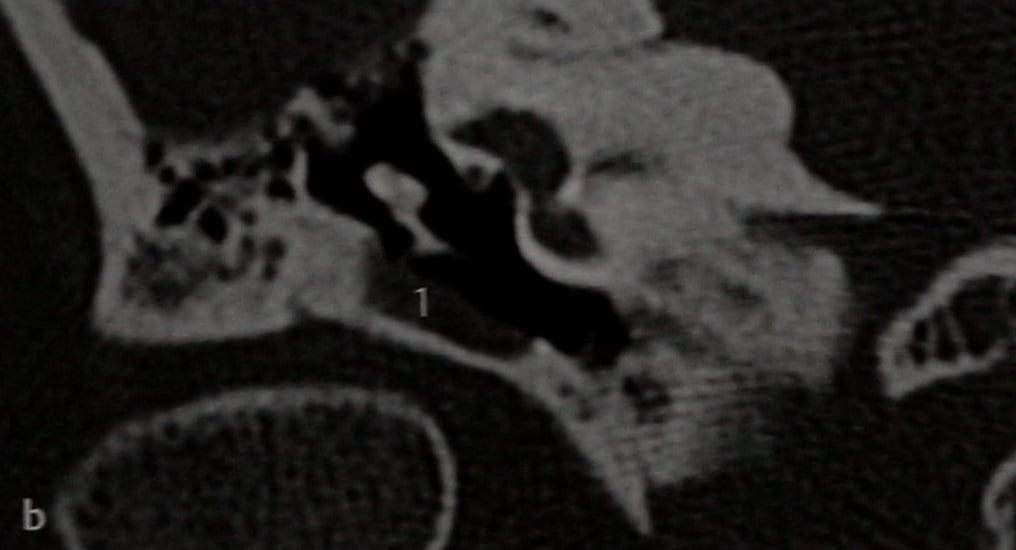 Снимки МРТ и КТ. Стеноз наружного слухового прохода
