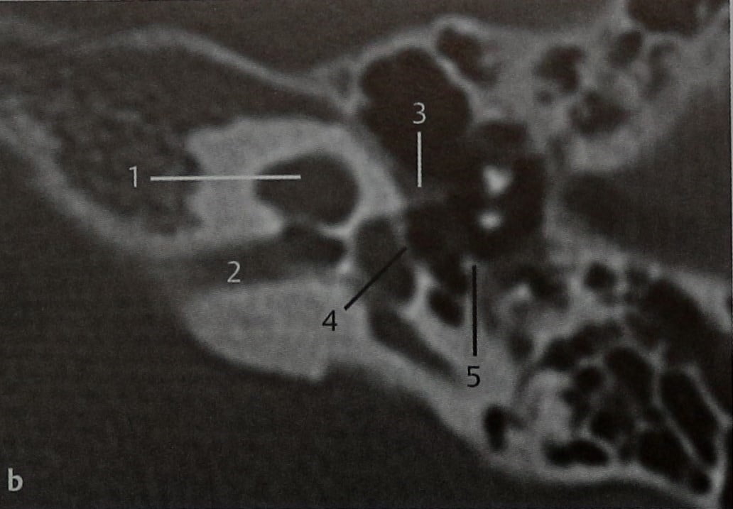 Снимки МРТ и КТ. Аномалии развития внутреннего уха