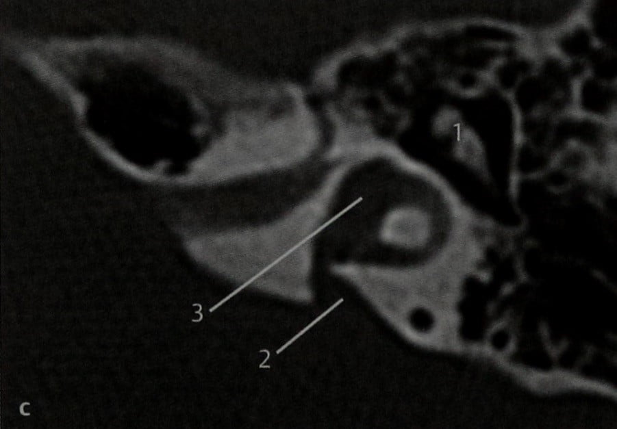 Снимки МРТ и КТ. Аномалии развития внутреннего уха
