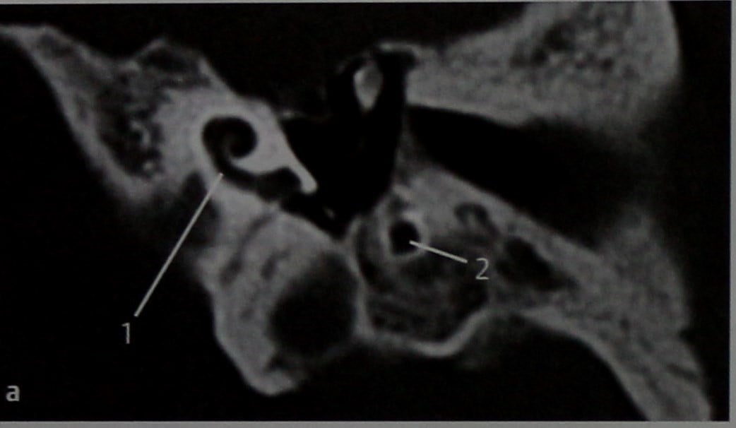 Снимки МРТ и КТ. Aномалии развития слуховых косточек