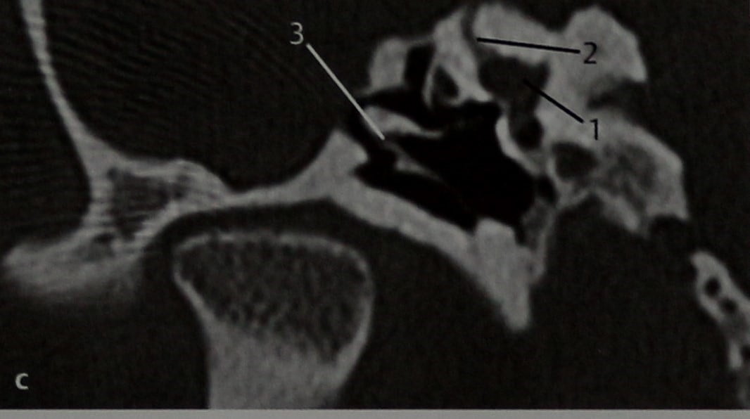 Снимки МРТ и КТ. Aномалии развития слуховых косточек