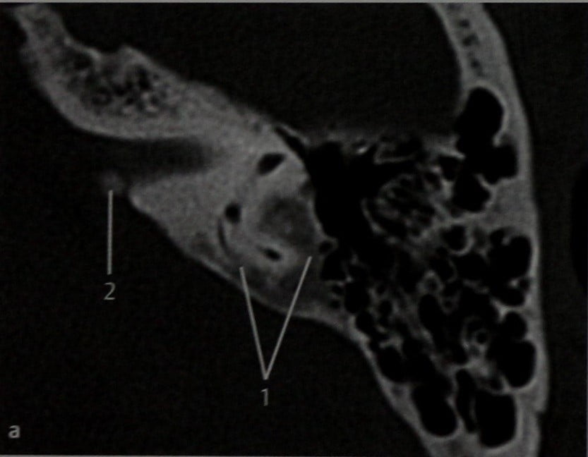Снимки МРТ и КТ. Фиброзная дисплазия