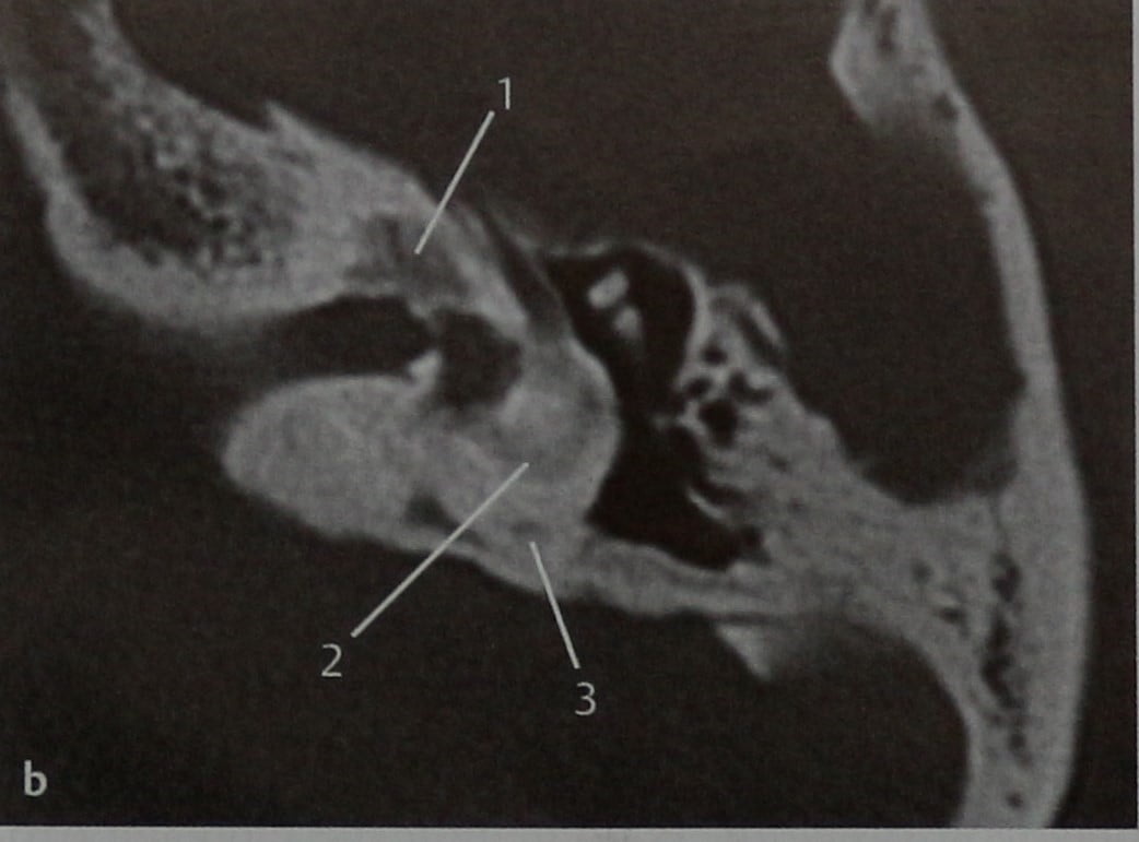Снимки МРТ и КТ. Оссифицирующий лабиринтит