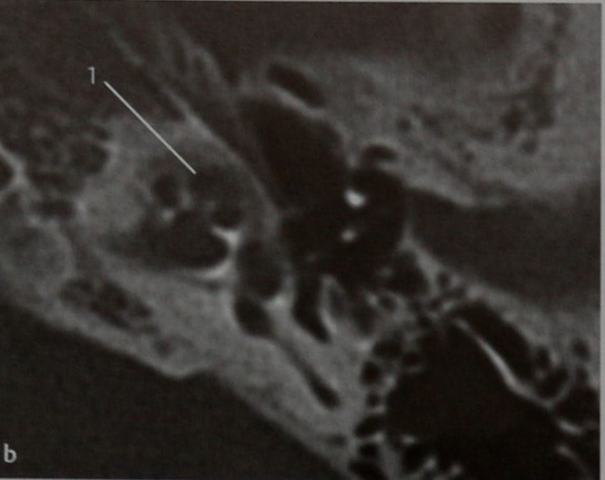 Снимки МРТ и КТ. Ретрофенестральный отосклероз