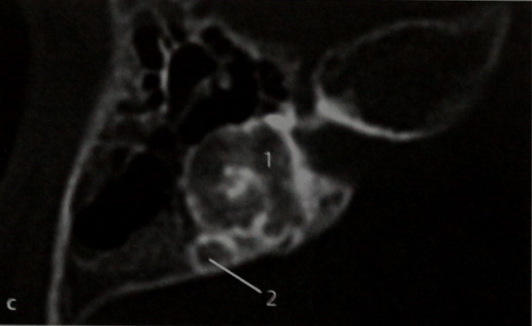 Снимки МРТ и КТ. Ретрофенестральный отосклероз