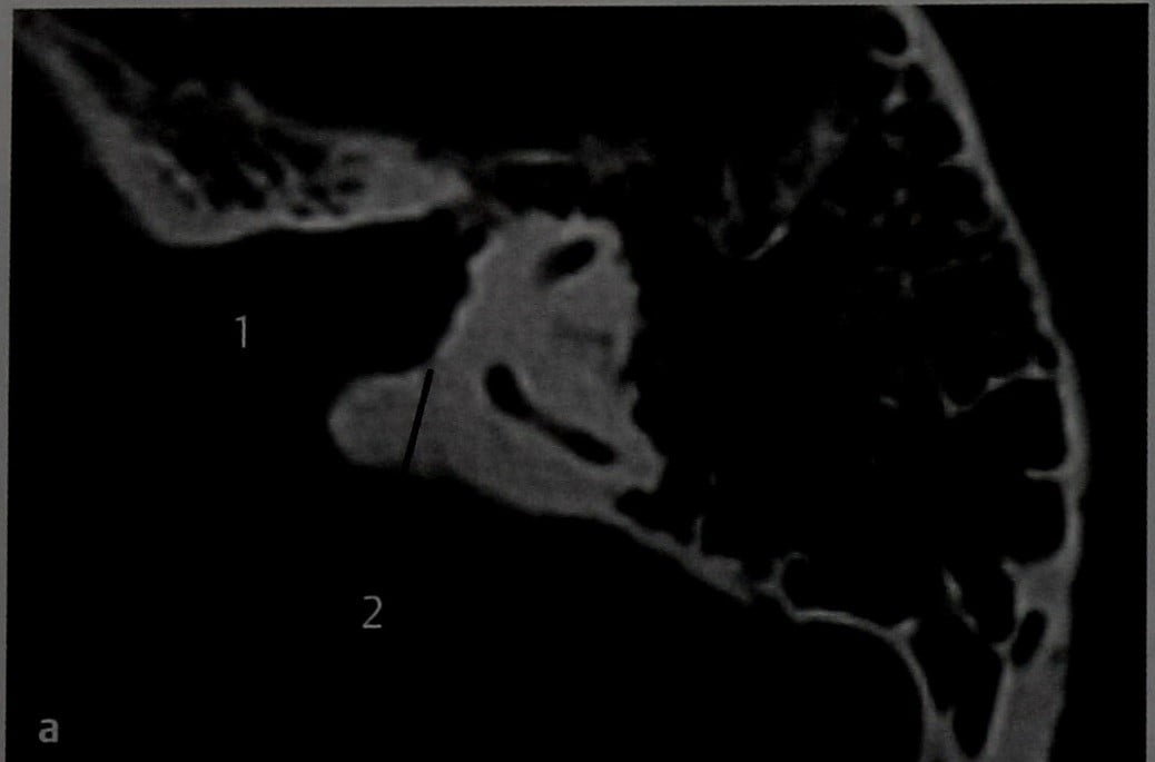 Снимки МРТ и КТ. Расширение внутреннего слухового прохода