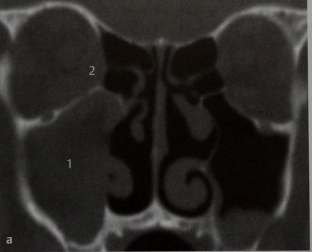 Снимки МРТ и КТ. Инвазивный грибковый синусит