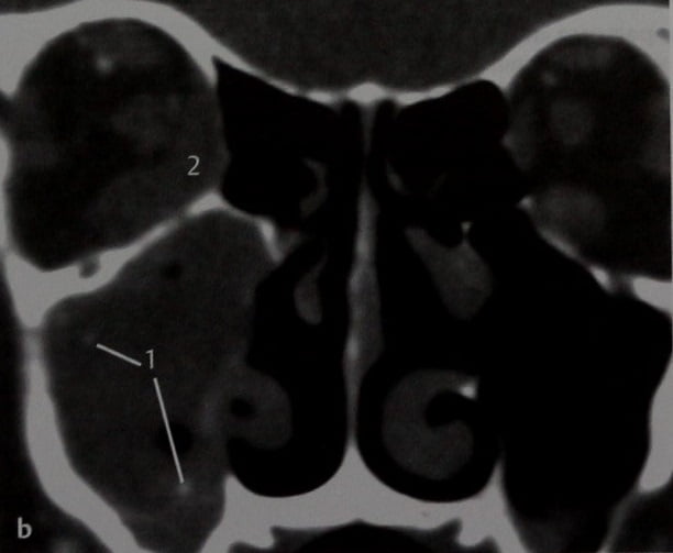 Снимки МРТ и КТ. Инвазивный грибковый синусит