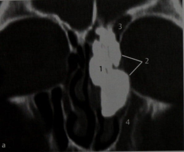 Снимки МРТ и КТ. Остеома, синдром Гарднера и его осложнения