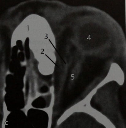 Снимки МРТ и КТ. Остеома, синдром Гарднера и его осложнения