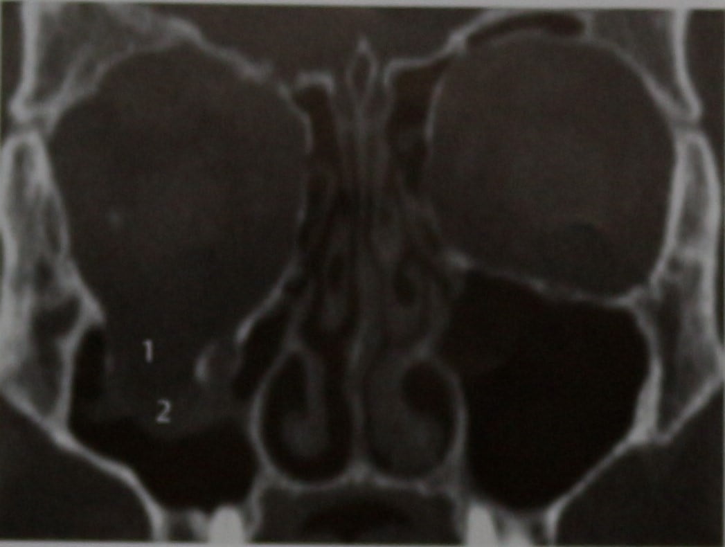 Снимки МРТ и КТ. Перелом переднего отдела черепа