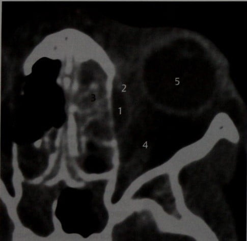 Снимки МРТ и КТ. Поднадкостничный абсцесс глазницы