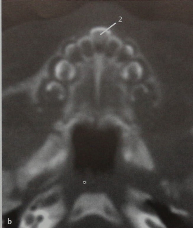 Снимки МРТ и КТ. Аномалии грушевидного отверстия