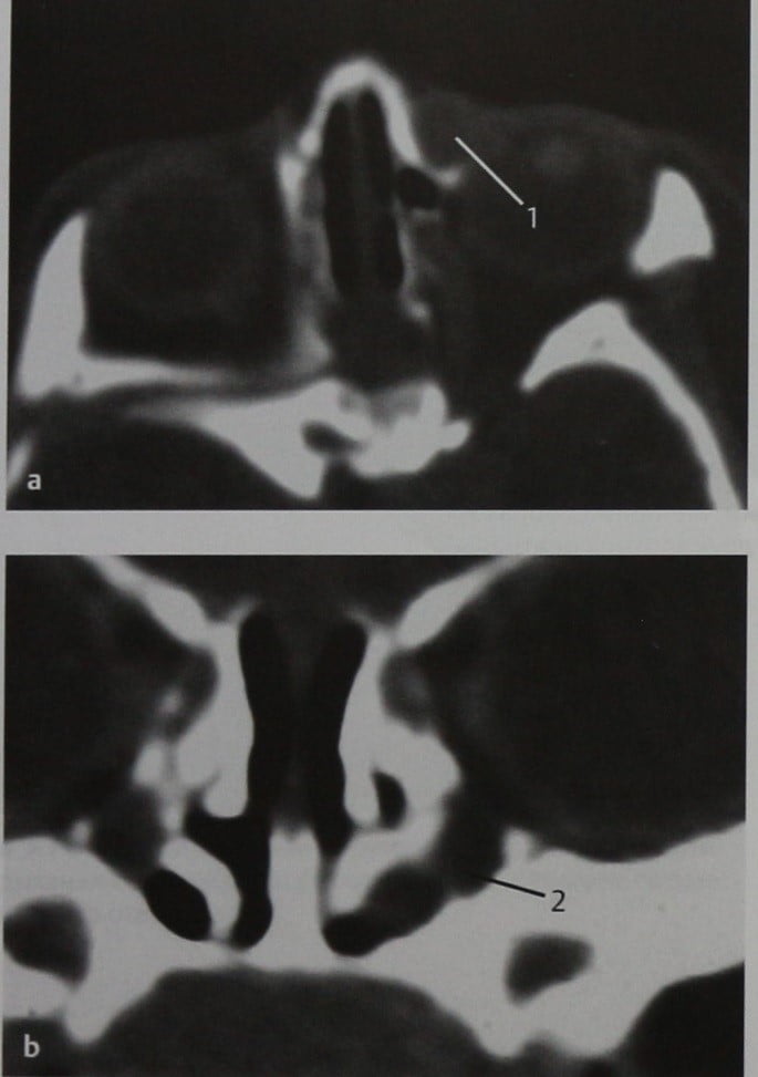 Снимки МРТ и КТ. Мукоцеле носослезного протока
