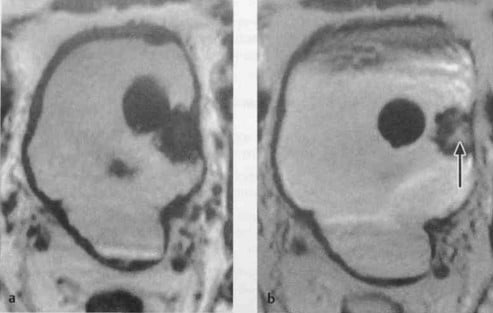 Снимки МРТ и КТ. Уротелиальный рак мочевого пузыря