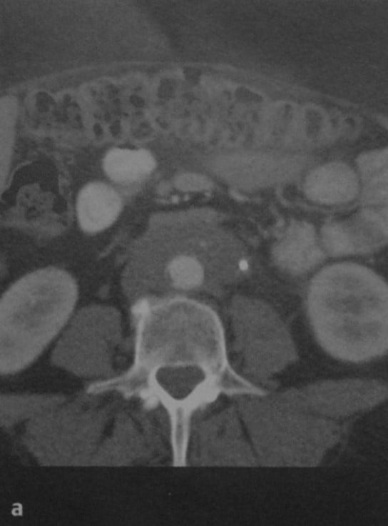 Снимки МРТ и КТ. Ретроперитонеальный фиброз
