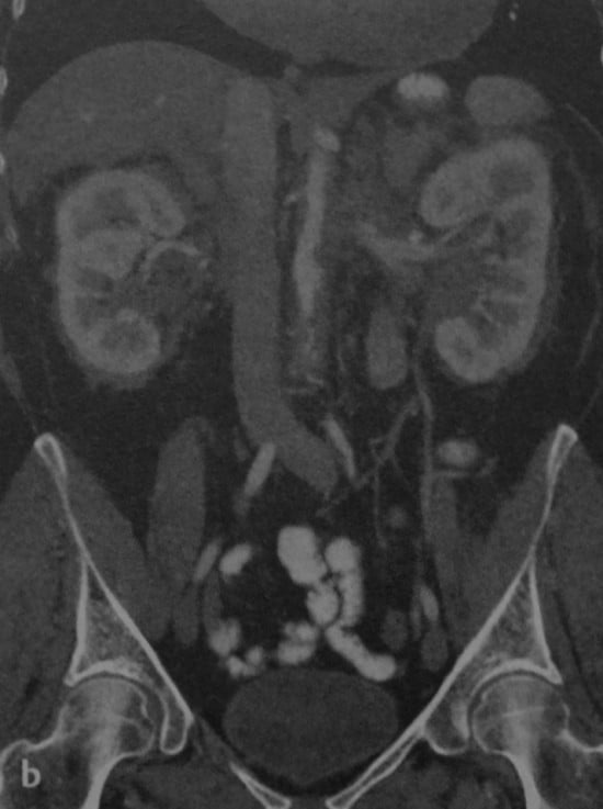 Снимки МРТ и КТ. Ретроперитонеальный фиброз