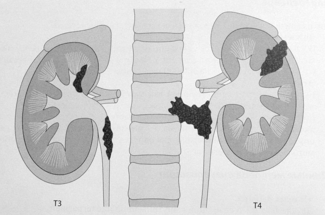 Снимки МРТ и КТ. Рак верхних отделов мочевыделительной системы