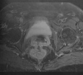 Снимки МРТ и КТ. Пузырно-влагалищные и пузырно-прямокишечные свищи