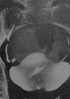 Снимки МРТ и КТ. Повреждения мочеточника