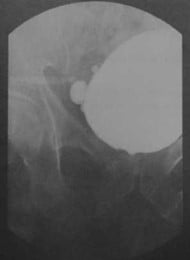 Снимки МРТ и КТ. Дивертикул мочевого пузыря