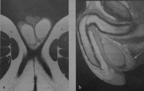 Снимки МРТ и КТ. Анатомия мошонки