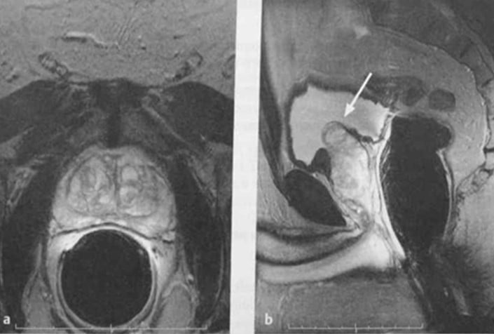 Снимки МРТ и КТ. Доброкачественная гиперплазия предстательной желез