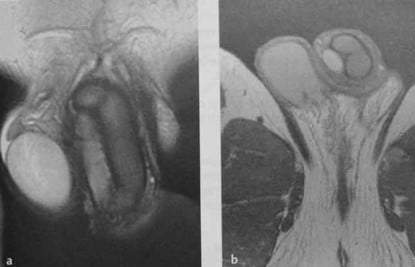 Снимки МРТ и КТ. Фиброз кавернозных тел полового члена
