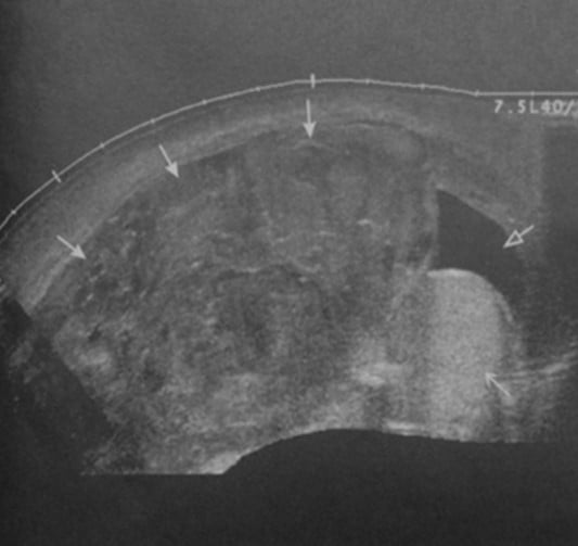 Снимки МРТ и КТ. Травма яичка