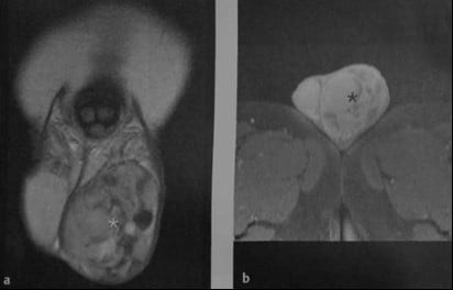 Снимки МРТ и КТ. Опухоли яичка