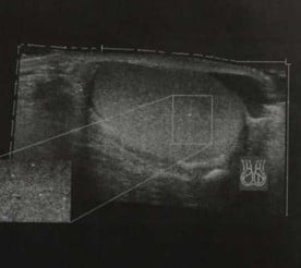 Снимки МРТ и КТ. Микролитиаз яичка