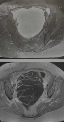 Снимки МРТ и КТ. Цистаденома яичника