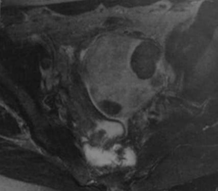 Снимки МРТ и КТ. Фиброма яичника
