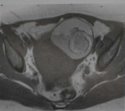 Снимки МРТ и КТ. Тератома яичника