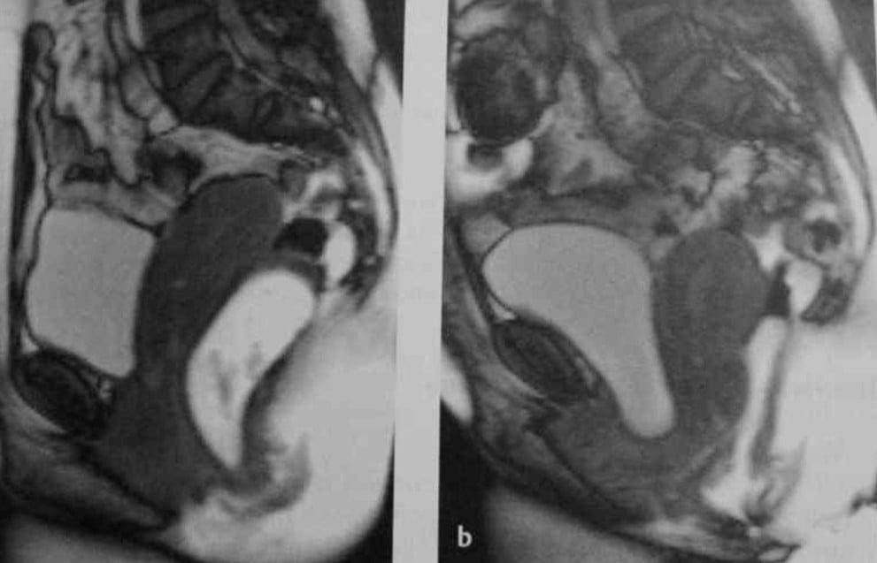 Снимки МРТ и КТ. Пролапс тазовых органов