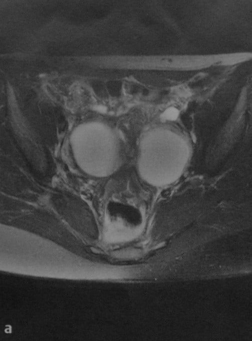 Снимки МРТ и КТ. Кисты яичника