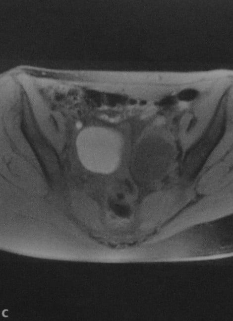 Снимки МРТ и КТ. Кисты яичника